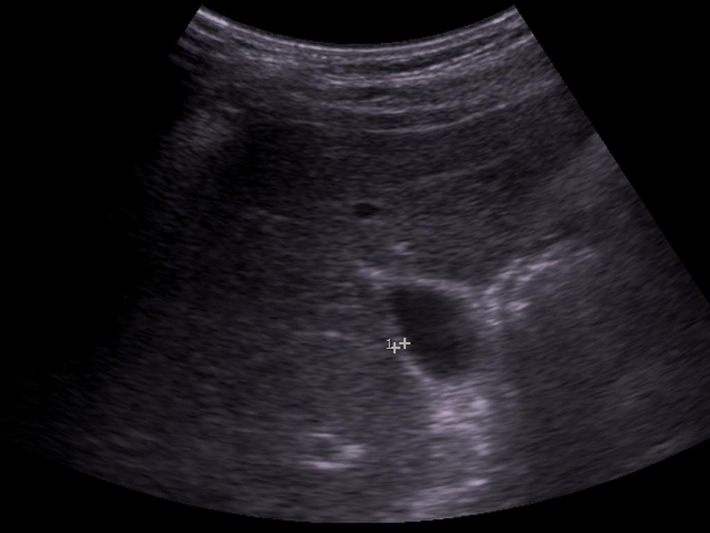 Minimum Gallbladder Imaging Guidelines: 1. Gallbladder in longitudinal...fig 2. Gallbladder transverse HI (near the neck) +/- calipers.