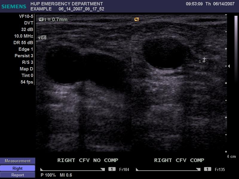 Dual screen of the Superficial Femoral Vein (mid-thigh) without/with compression (calipers over compressed vein)...fig 3.