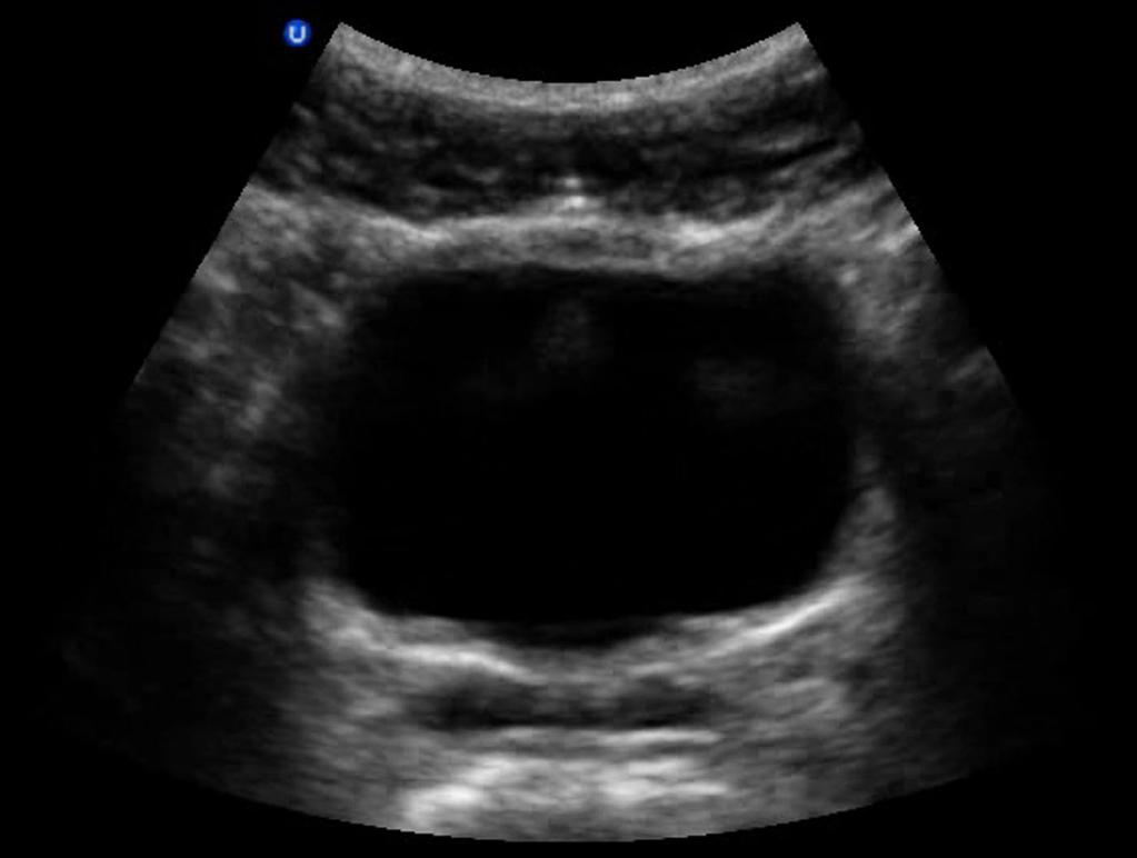 Minimum FST Imaging Guidelines: 1. RUQ (one or more views to show pleural space, subphrenic space, Morison s, and inferior pole of the kidney)...fig 1.
