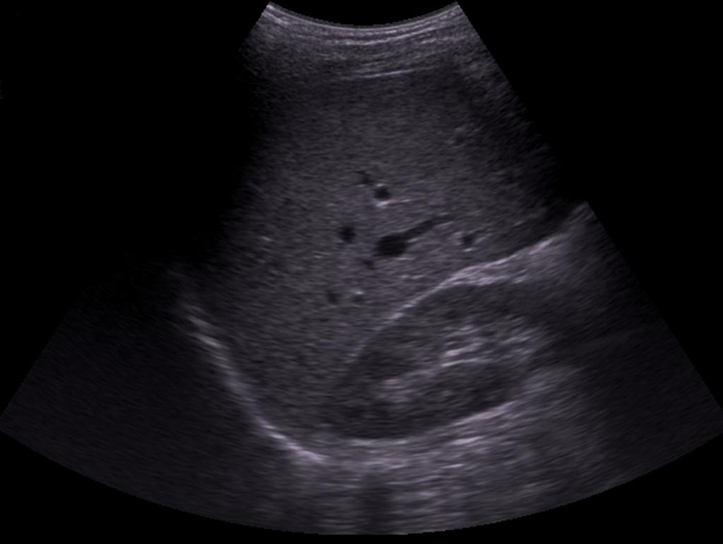 ..fig C (lternative if SX not available: Parasternal long axis...click her for example) 3. Suprapubic view in transverse.