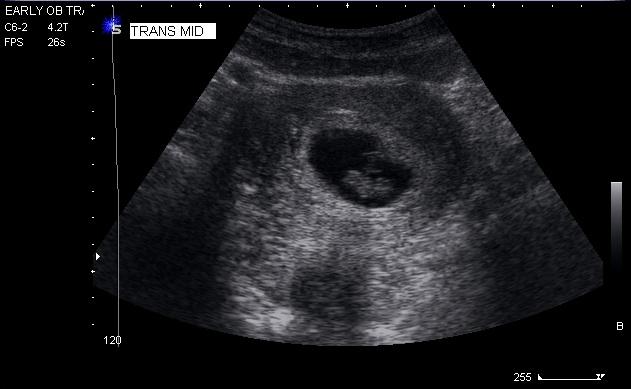 Minimum O Transabdominal U/S Imaging Guidelines: 1. Uterus in longitudinal...fig 2.