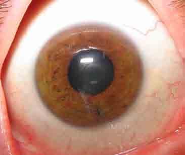 OCULAR INJURIES RE: Inferior corneal
