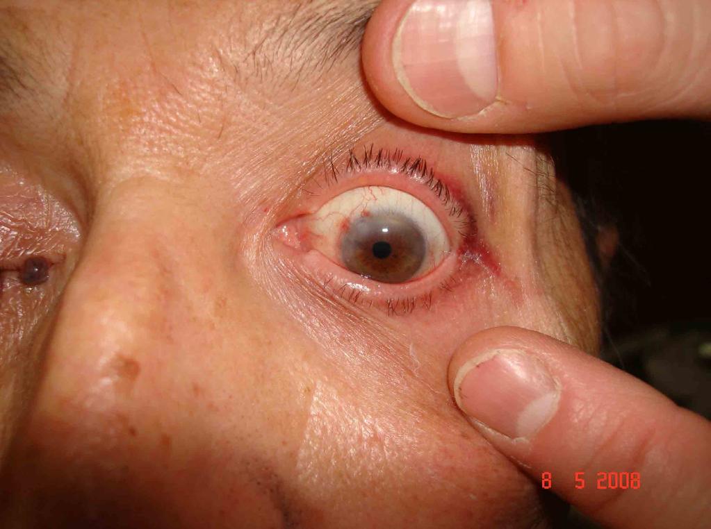 POST SURGERY Cataract
