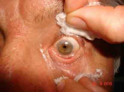POST SURGERY Cataract