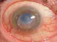 keratopathy stage 3 (corneal
