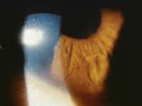 OCULAR INJURIES Chemical burns TCL may inhibit the passage of certain proteolytic enzymes present in the tear film to the stroma, thus preventing the progressive ulcerative process For peripheral