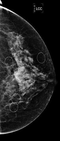 Mammography MBI