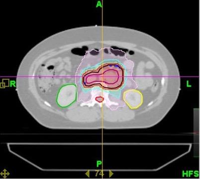 Axial view showing planning target volume and isodose distribution using