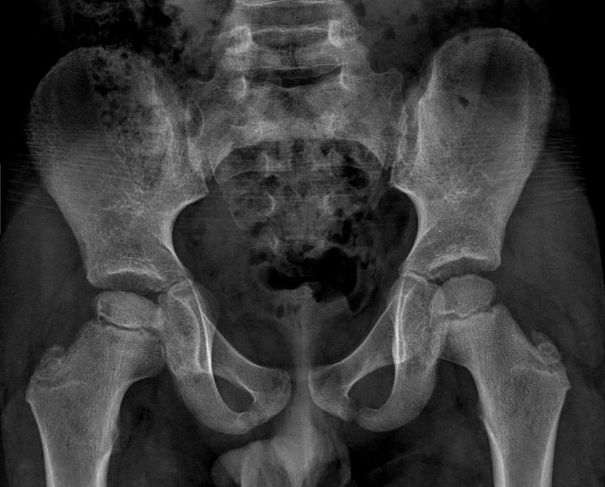 5 year-old boy with limping and pain