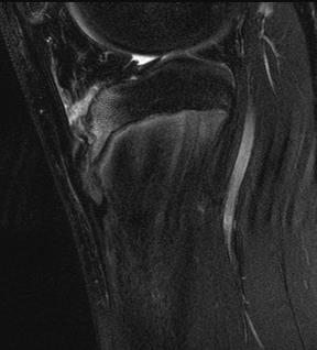 Osgood-Schlatter Disease Stress injury in the tibial tubercle Transition from