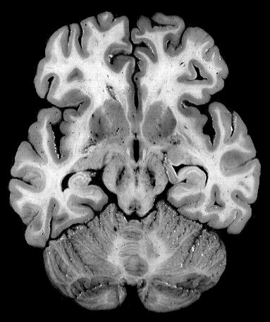 . What structure is indicated by the number? Participant Participant Participant Participant Participant %. %. %. %. %. Corpora quadrigemina Mamillary bodies Substantia nigra :. %. %. %. % Frontal Parietal Temporal Occipital Insula.