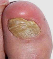 Toenail Fungus Toenail fungus, or onychomycosis, is an infection underneath the surface of the