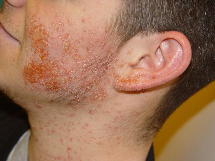 Impetigo Superficial bacterial infection of the skin Most