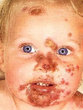 vesicles with honey colored crusting Usually on face, hands,