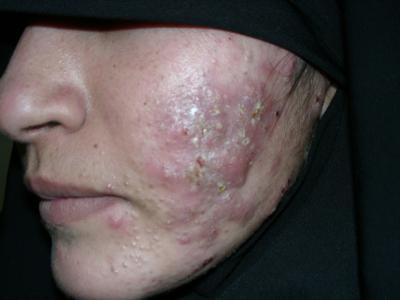 Causes: Bacteria Acne vulgaris
