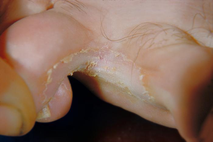 Tinea Pedis Fungal infection - Athlete s Foot, is caused by fungi such as