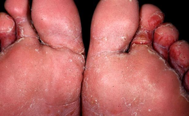 Globally, athlete's foot affects about 15% of the population.