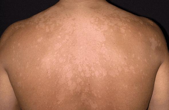 Tinea Versicolor Fungal infection of the skin Multiple patchy