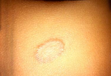 Tinea Corporis Fungal infection of skin - Ring Worm Well defined circular patches with scaly borders Found on