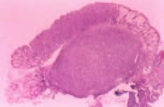Colonic metastases from gastric carcinoma A C B Figure 5.