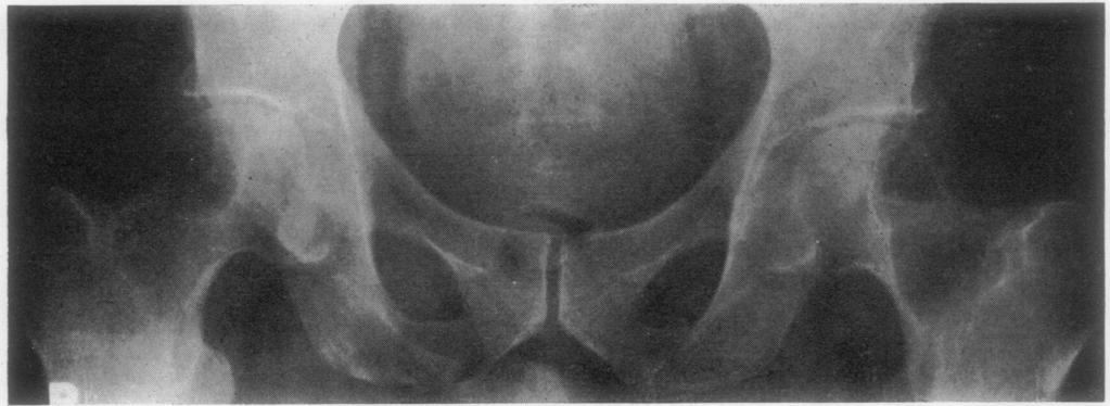 Ann. rheum. Dis. (1970), 29, 626 Giant granulomatous lesions of the femoral head and neck in rheumatoid arthritis C. L. COLTON AND A. J.
