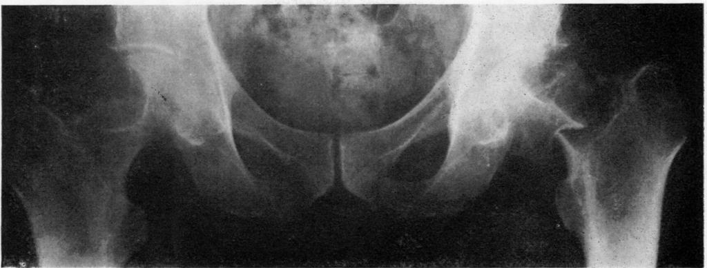 Granulomatous lesions offemoral head and neck 627 FIG. 2 Case 1. Later radiograph, showing a fracture through left femoral neck at site of osteolytic lesion.