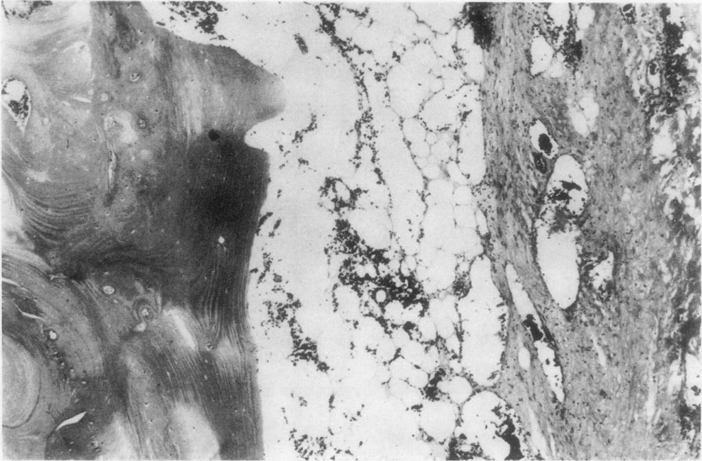 ' ~~~~~~~~~~~~~~~~~~~~~1.ft' The subsequent course was interrupted on the fourth FIG. 5 Case 1. Photomicrograph of margin of osteolytic lesion.