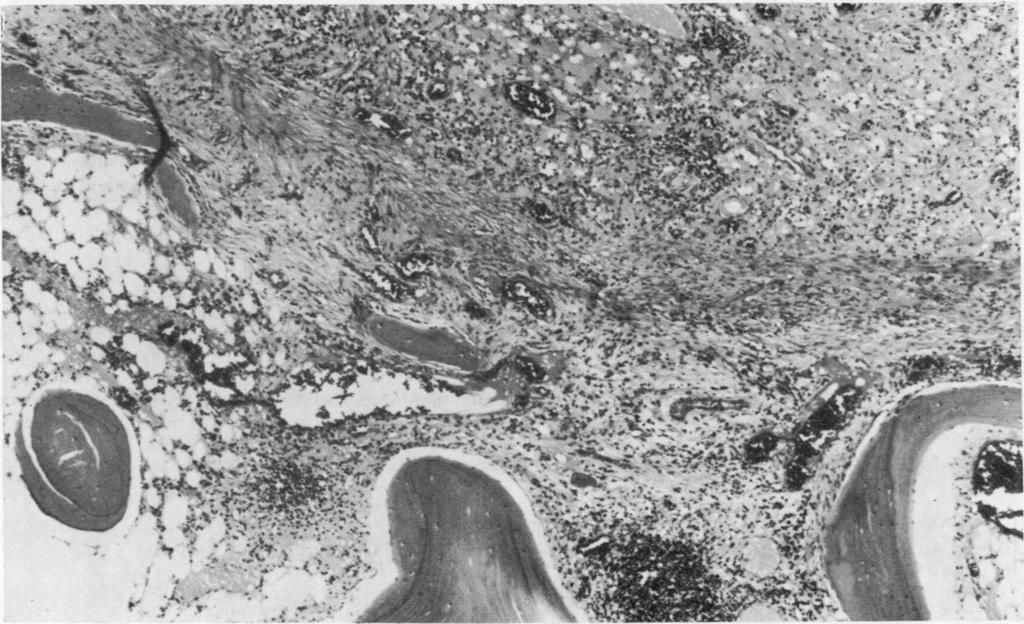 ."N 1~~~~~~~~~~~~~~~~~~~~~~~~~~~~~~~~~~~~~~~~~~~1 FIG. 9 Case 2. Photomicrograph of margin of osteolytic lesion.