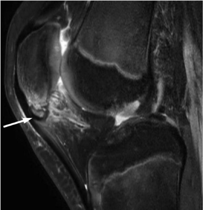 Patellar tendon proximal Traction apophysitis distal in