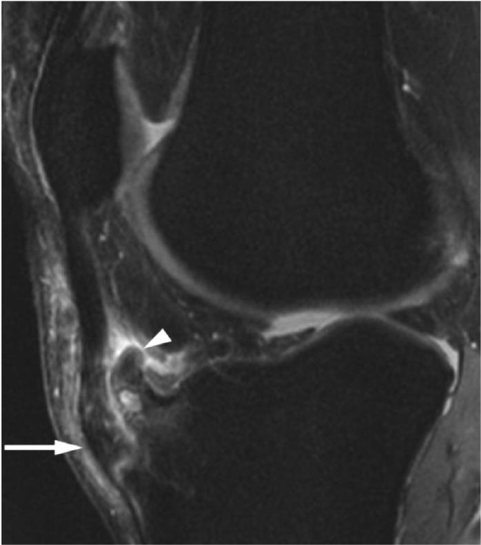 patellar pole - tibial tuberosity bone fragmentation, edema