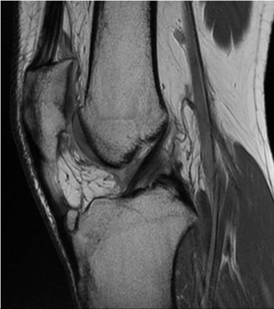 Patellar tendon proximal Traction apophysitis distal in adolescents