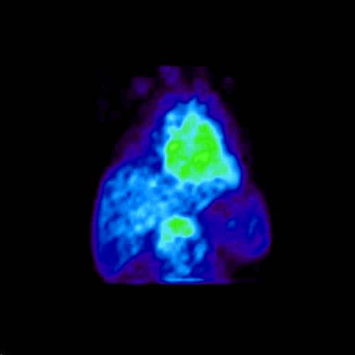 19.6. NON-HODGKIN S LYMPHOMA 19.6.1. Treatment specific issues Some studies assess biodistribution and dosimetry based on Bremsstrahlung imaging.