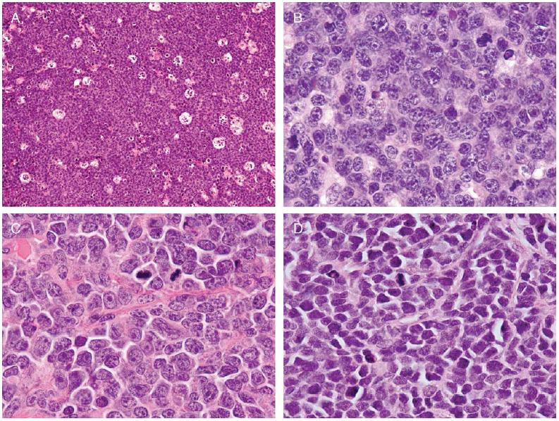 Double hit B-cell lymphomas B-cell lymphomas characterized by a recurrent chromosomal translocation in combination with a MYC/ 8q24 breakpoint DH lymphomas are rare (0-12%)