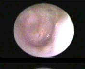 An ear discharge case study To explore bacterial load in