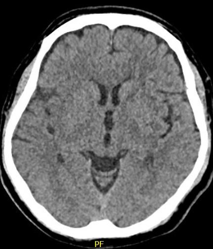 Cryptogenic Strokes: Evaluation and Management 77 yo man with hypertension and