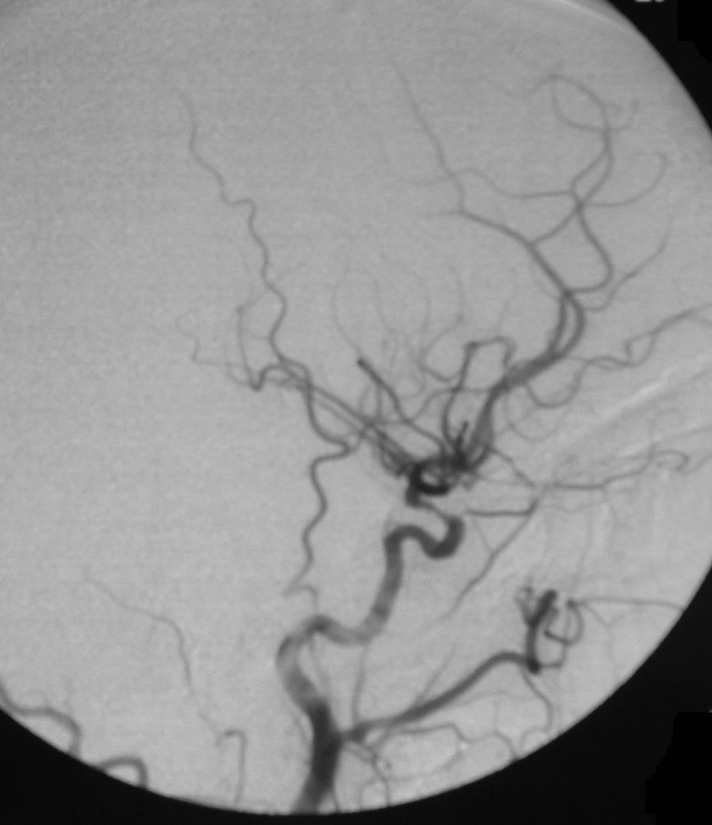 Moya-Moya LICA RICA Other Causes Obliterative arteropathy with b/l distal intracranial ICA occlusions or highgrade stenoses Hypercoaguable States Cancer Antiphospholipid antibody syndrome Usually
