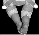 Apply Limb Cuffs to the lower thighs with closure tabs on the inner side of the thighs. 2.