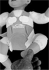 Apply Limb Cuffs to lower thighs with tab closures on the outside. 2. Turn the Cross Strap sideways and lay the bridge across the child s midback (Fig. 30