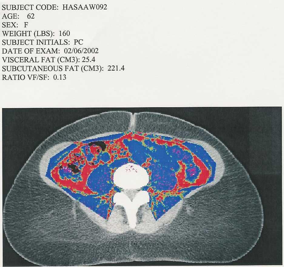 Visceral Adipose Tissue by Computed Tomography African
