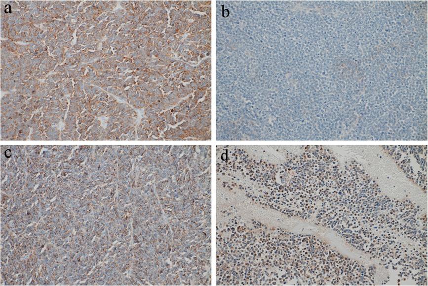 Uchiyama et al. World Journal of Surgical Oncology 2012, 10:115 Page 4 of 5 Figure 1 Immunohistochemical expression for markers in primary tumor (Case 1).