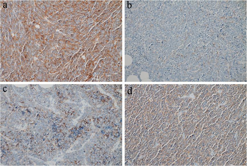 We studied the characteristics of G-NECs by means of pathological and immunohistochemical examination of both the primary sites and metastatic lymph nodes.