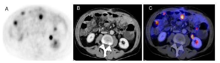 PET/CT for detection of Peritoneal
