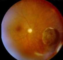Diagnosis and Prognosis Primary vitrectomy Transillumination gives information about basal infiltration in order to define tumor borders, impeded by vitreous hemorrhage 1.