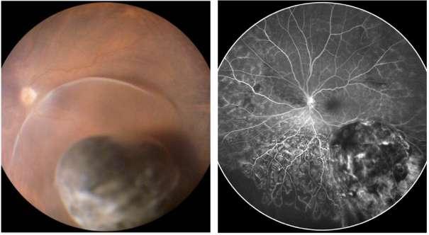 retinopathy and