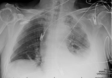 Case #4 80 y/o male fell off skateboard Sustained left rib fx 4-12 Admitted at outside facility 7 days--discharged home Chest x-ray and CT done Repeat chest x-ray for 2 days then DC x-ray