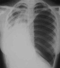 Life Threatening Injuries Tension Pneumothorax Flail Chest w/ pulmonary contusion Open chest wounds Massive Pneumo/Hemothorax