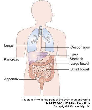Types of NETs Gastrointestinal NETs Duodenum Pancreas Appendix Rectum Small/Large
