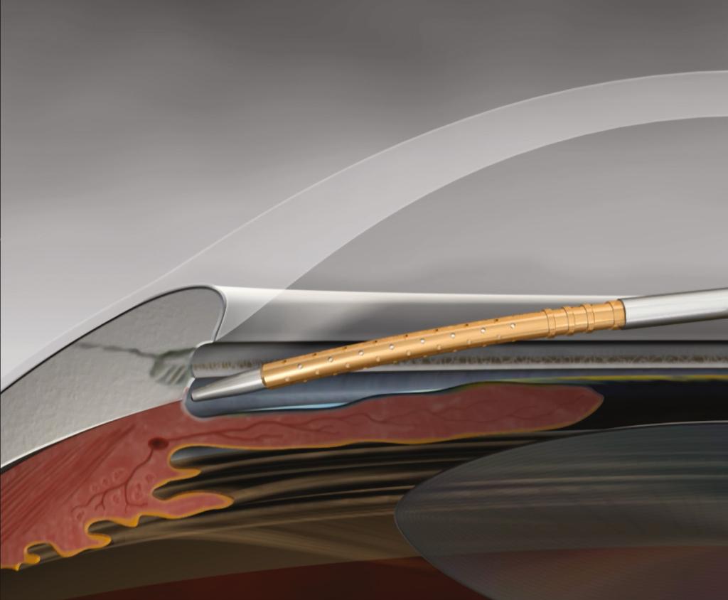 CYPASS MICRO-STENT SYSTEM OFFERS A MINIMALLY INVASIVE, INTUITIVE IMPLANTATION