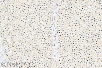Optimal S100 staining of the malignant