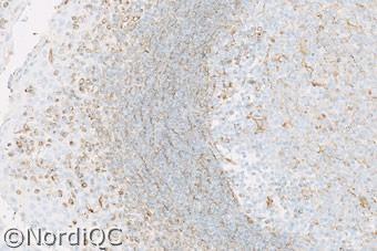 Insufficient Vimentin staining in